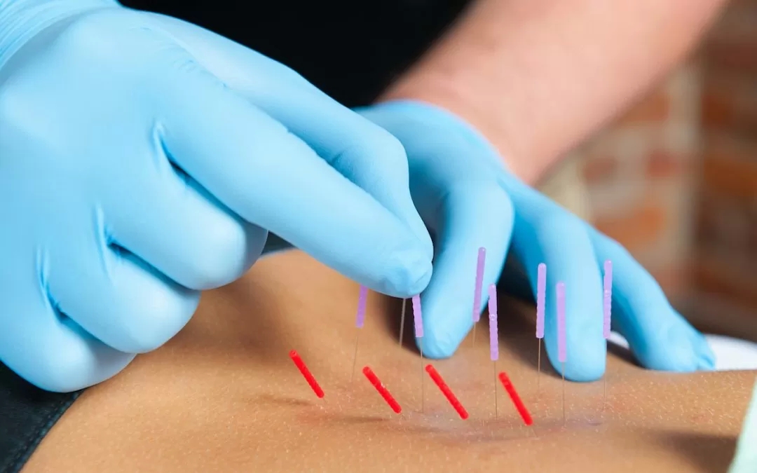 What are the side effects of Dry Needling?